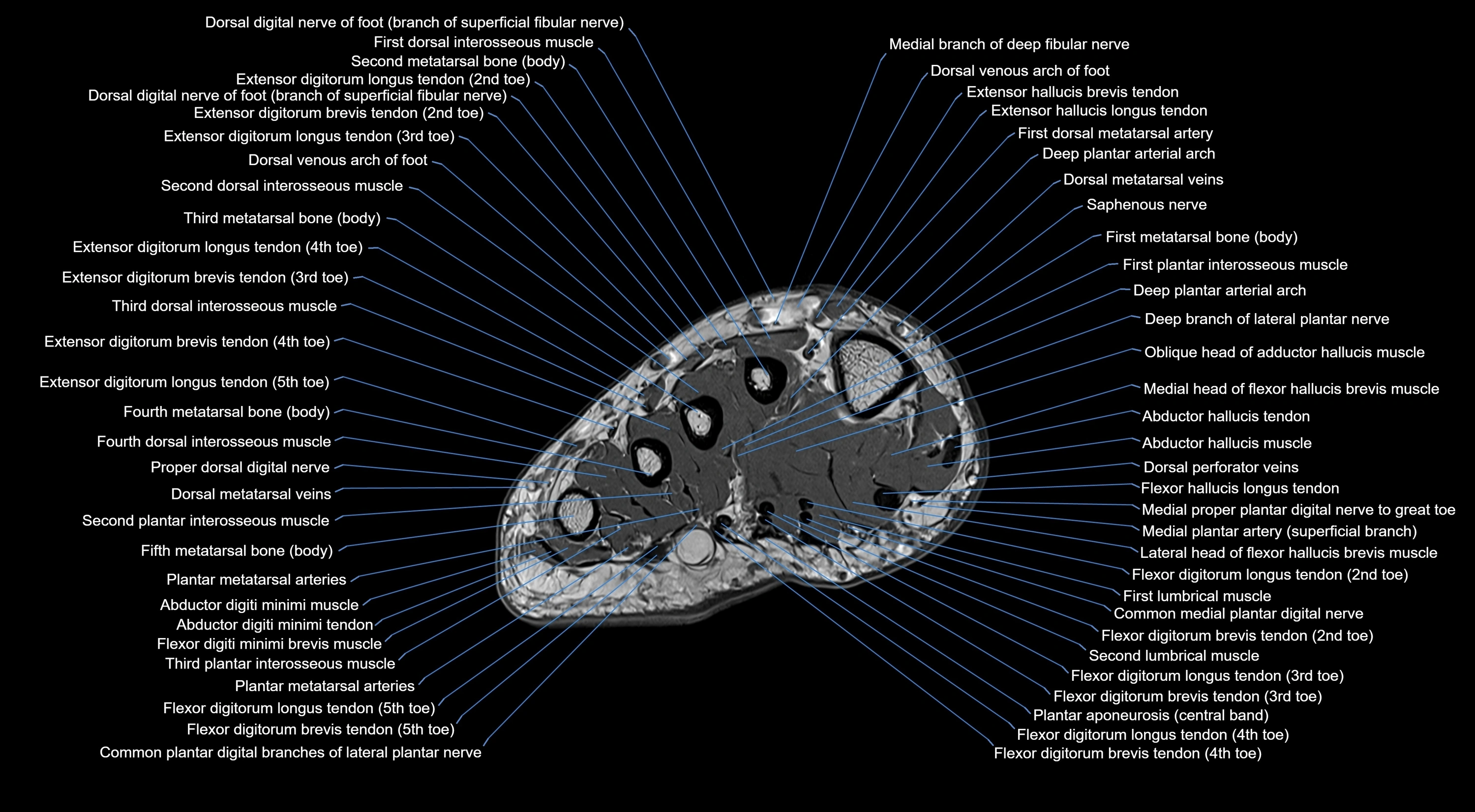 MRI mid foot coronal ligaments cross sectional anatomy 3T  radiology  image-img-00001-00002.webp
